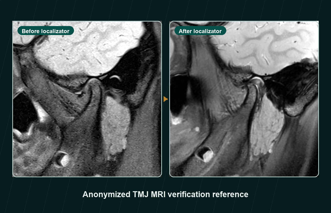 Anonymized before and after TMJ MRI verification reference