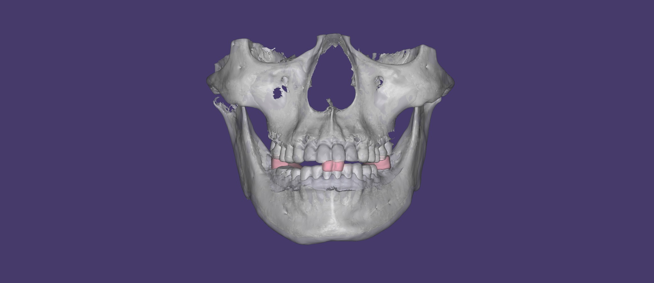 CBCT skull and CAD position carrier for AxisGuide planning