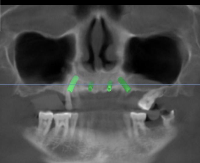 CBCT implant position reference for full-arch implant rehabilitation planning