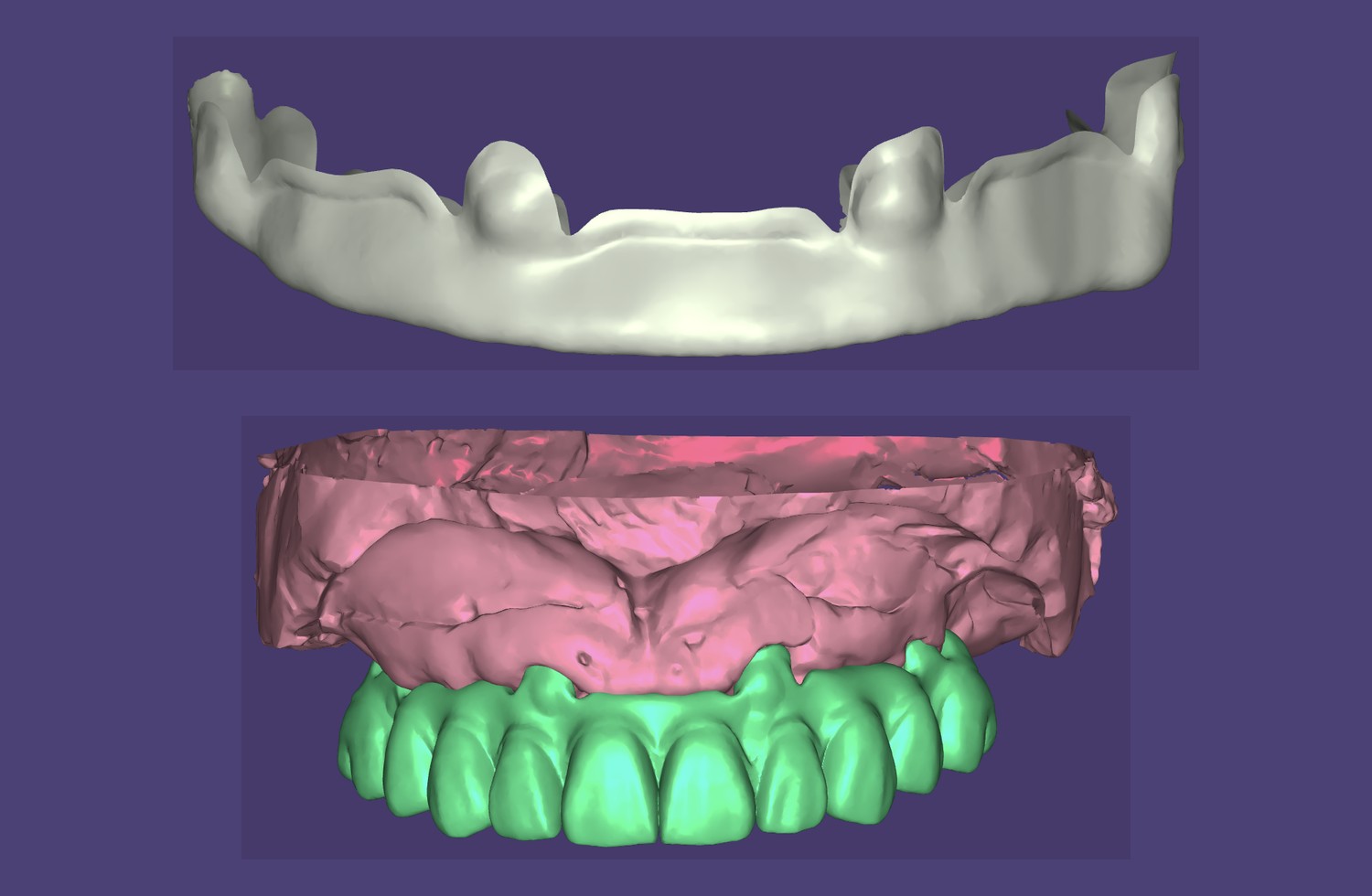 Full-arch prosthetic setup planning CAD reference
