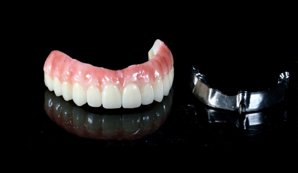 Full-arch implant provisional prosthesis and metal framework